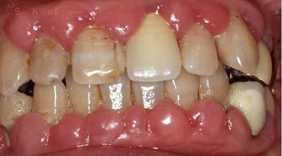 歯周病治療：治療前