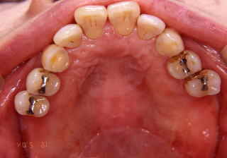 左右大臼歯4本欠損