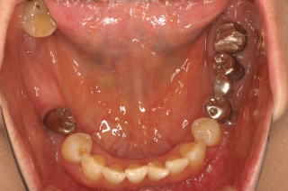 大臼歯2本欠損
