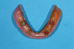 下顎の入れ歯の裏面インプラント部と凹凸のあるロケータ（ホック）で装着します。