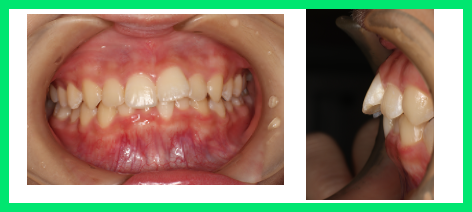 歯の前突と歪みを施術