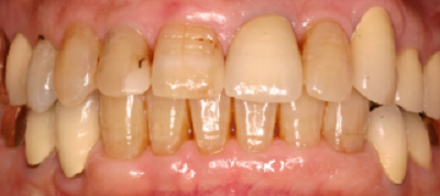 歯周病治療：治療後