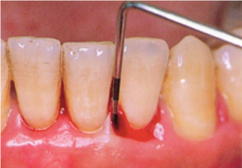 歯周治療の流れ