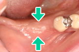 骨を増やす治療後骨の幅が増加